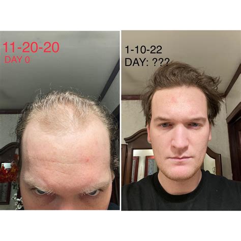finasteride for hair loss reddit